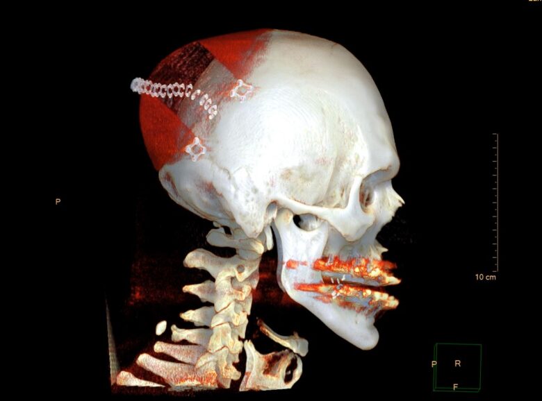 A 3D model of a patient-specific occipital prosthesis.