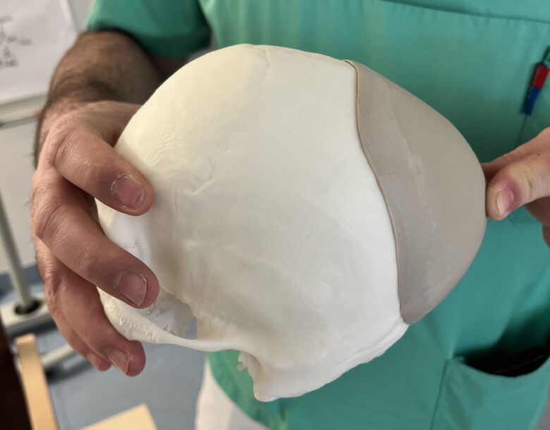 A 3D-printed PEEK cranial implant created by Salzburg University Hospital.